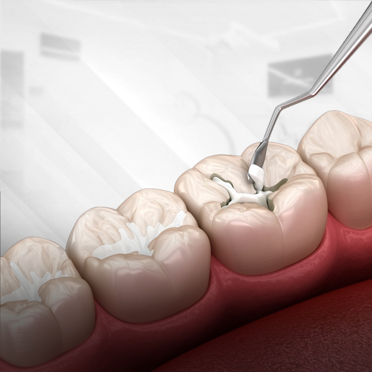 Cosmetic filling image