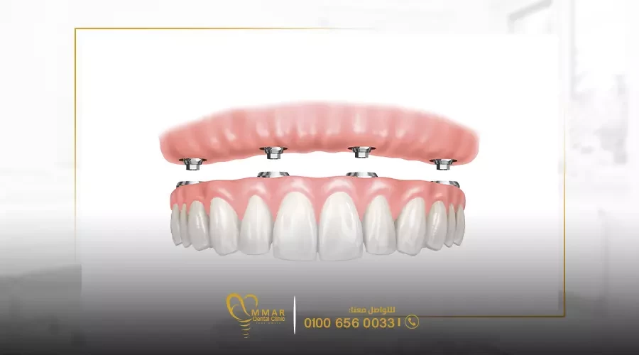 3D printed jaw implants image
